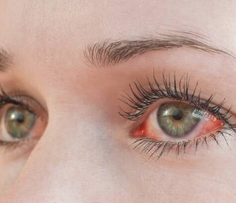 Red irritated human eye close up, allergy symptom